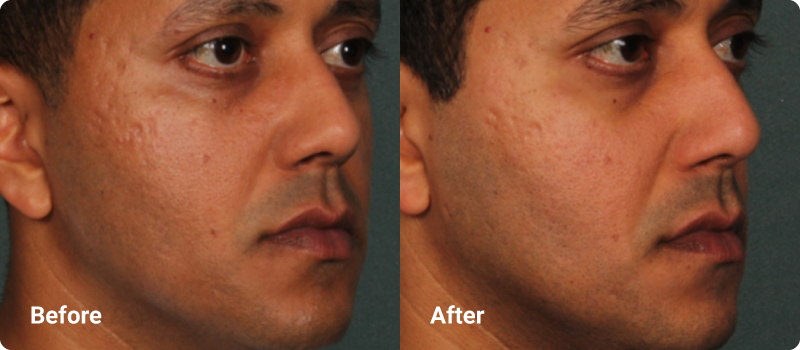 sofwave before after acne scars