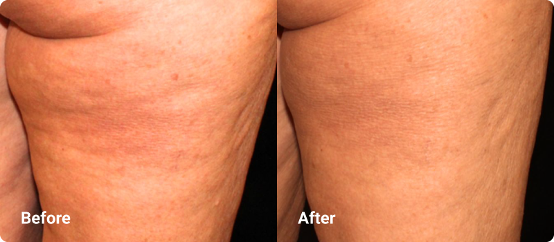 sofwave before after cellulite