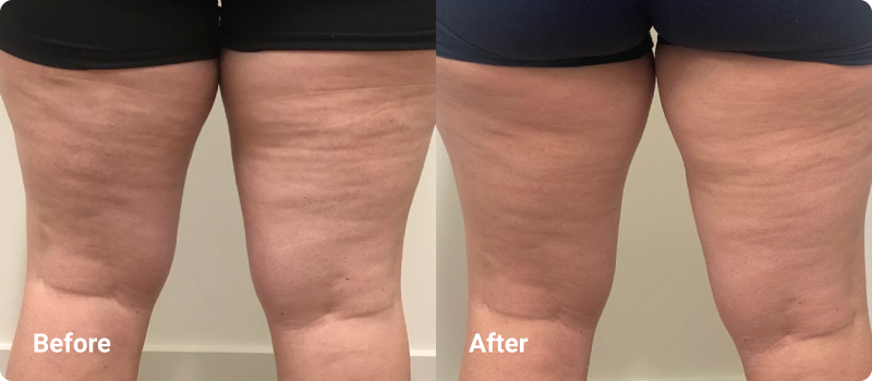 sofwave before after cellulite