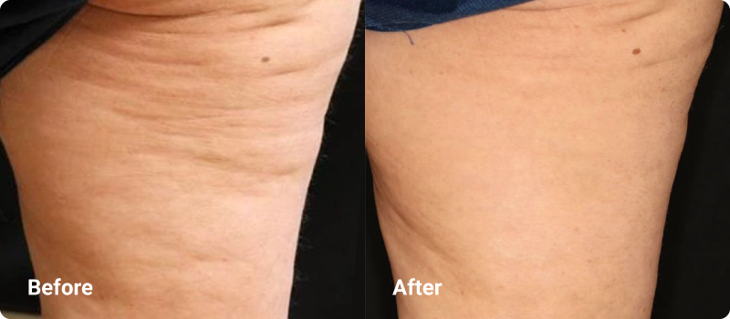 sofwave before after cellulite