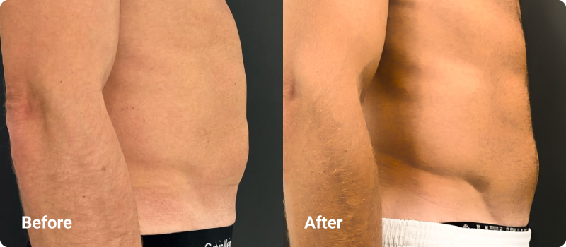 sofwave before after muscle toning