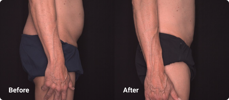 sofwave before after muscle toning