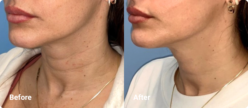 sofwave before after neck
