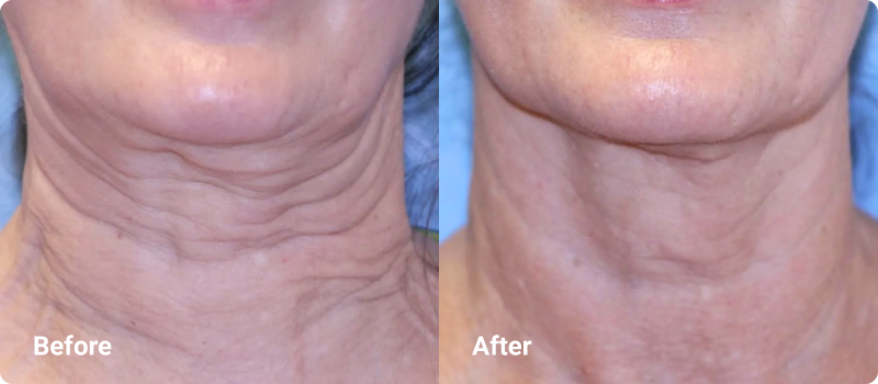 sofwave before after neck