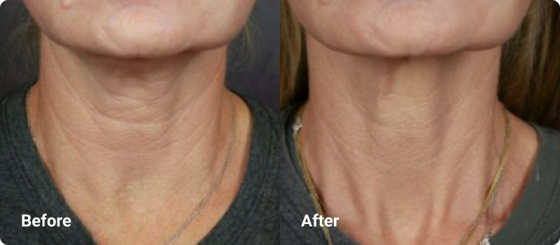sofwave before after submental