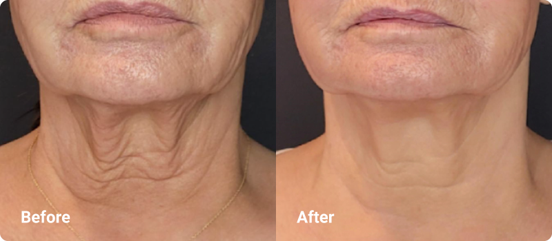 sofwave before after submental