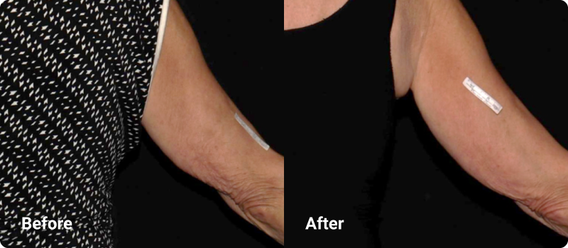 sofwave before after upper arms