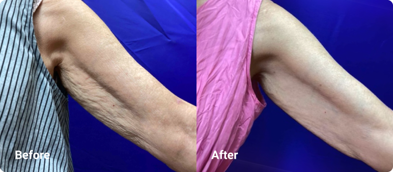sofwave before after upper arms