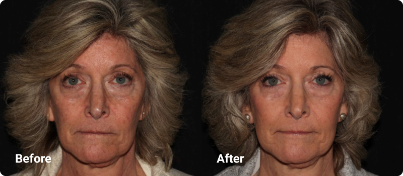 sofwave before after wrinkles