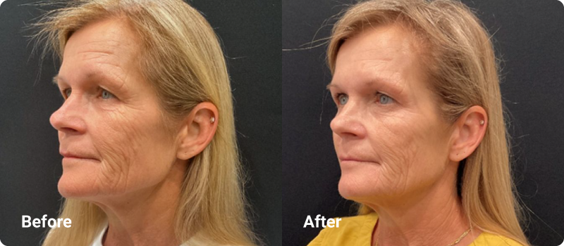 sofwave before after wrinkles
