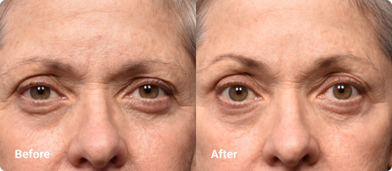 sofwave brow before after
