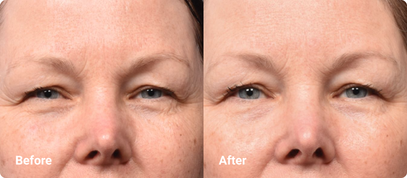 sofwave brow before after